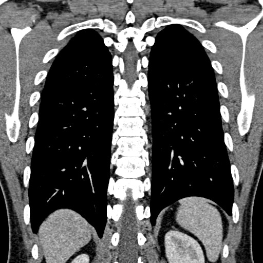 Apical lung mass mimic - neurogenic tumor (Radiopaedia 59918-67521 B 82).jpg