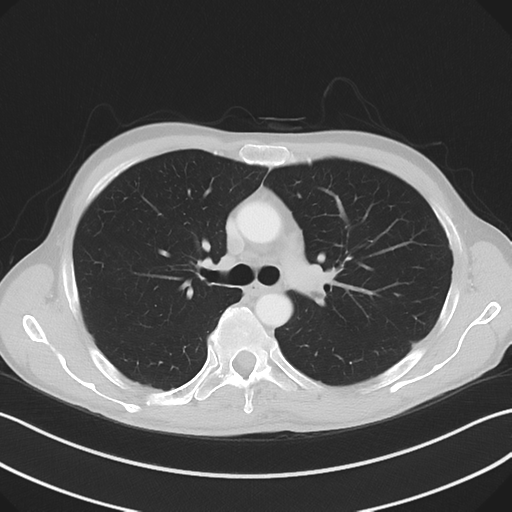 Apical pleural calcification (Radiopaedia 46141-50499 Axial lung window 26).png