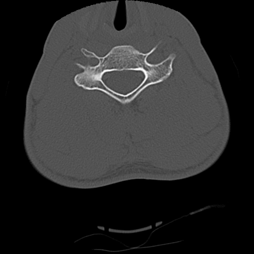 File:Apical pneumothorax on cervical spine CT (Radiopaedia 45343-49368 Axial bone window 59).jpg