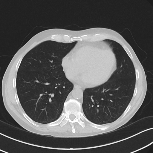 Apical pulmonary metastasis (Radiopaedia 46338-50754 Axial non-contrast 44).png