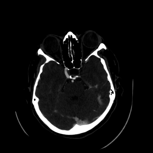 File:Aplasia of the internal carotid artery (Radiopaedia 61082-68960 A 23).jpg