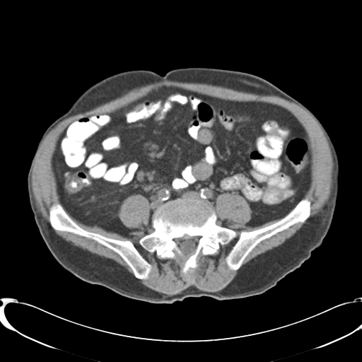 File:Appendiceal abscesses (Radiopaedia 50999-56542 Axial non-contrast 52).png