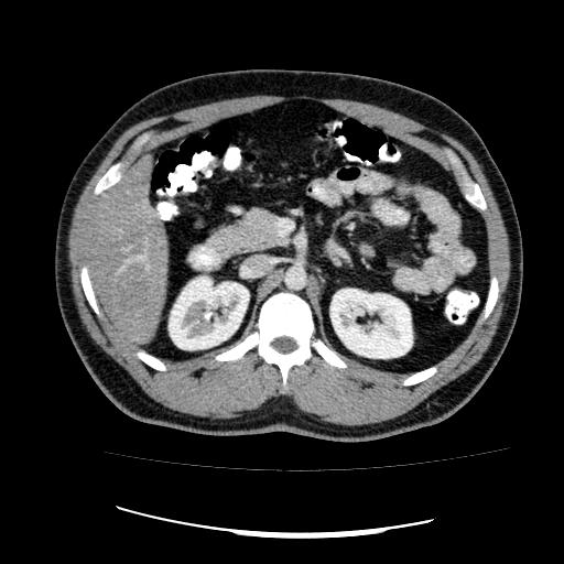 File:Appendicitis with diverticulosis (Radiopaedia 47693-52383 Axial C+ 48).jpg