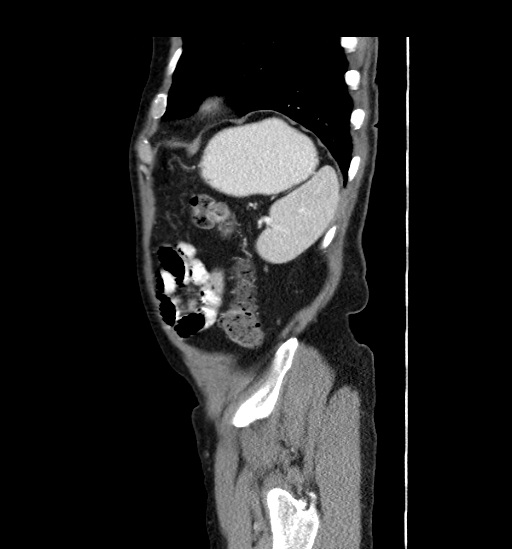 Appendicitis with localized perforation and abscess formation (Radiopaedia 49035-54130 C 55).jpg