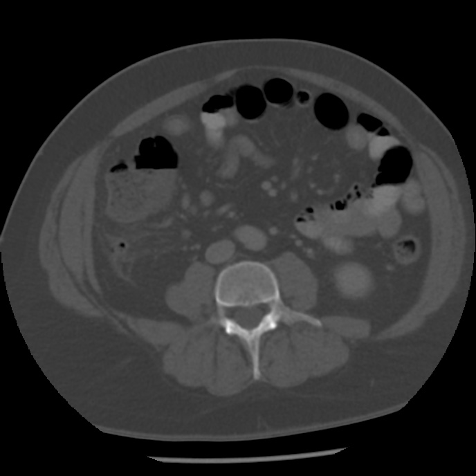 Appendicitis with perforation (Radiopaedia 35790-37342 Axial bone window 29).jpg