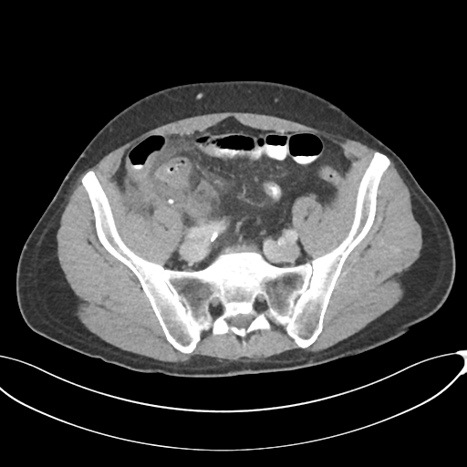 Appendicitis with thickening of the terminal ileum (Radiopaedia 42432-45550 A 74).png