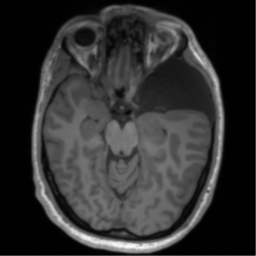 File:Arachnoid cyst with subdural hematoma (Radiopaedia 85892-101743 Axial T1 37).png