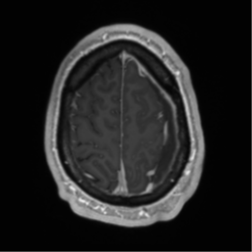 Arachnoid cyst with subdural hematoma (Radiopaedia 85892-101743 Axial T1 C+ 71).png