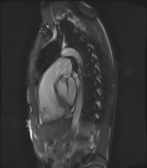 File:Arrhythmogenic right ventricular cardiomyopathy (Radiopaedia 57972-64966 Cine RVOT SSFP 5).jpg