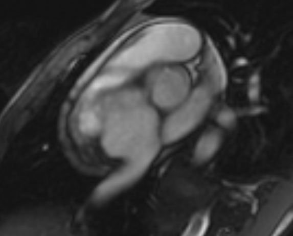 Arrhythmogenic right ventricular cardiomyopathy (Radiopaedia 69564-79464 short axis cine 261).jpg