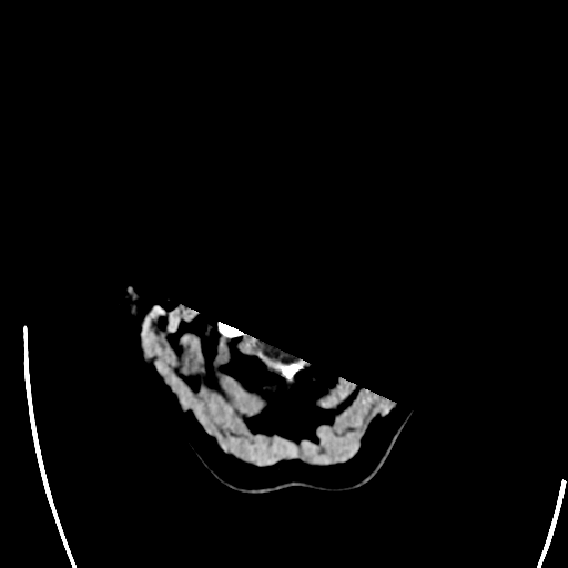 File:Arteriovenous malformation (cerebral) (Radiopaedia 40070-42579 Axial non-contrast 2).png