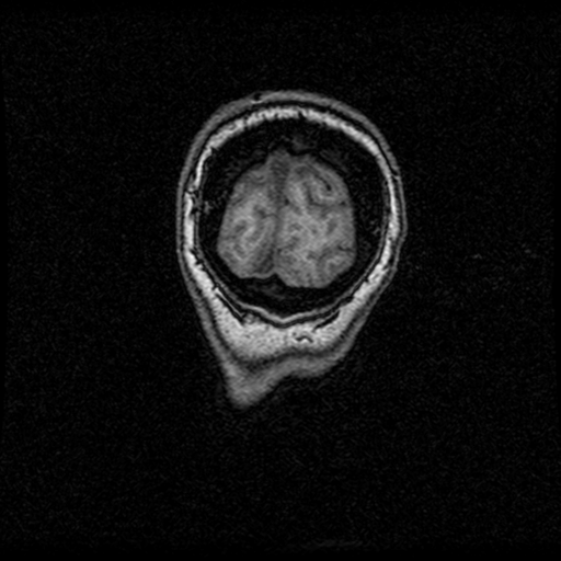Arteriovenous malformation (cerebral) (Radiopaedia 40070-42580 Coronal T1 4).png