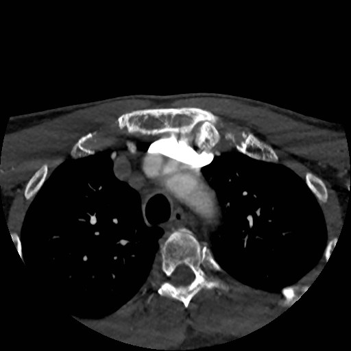 Artery of Percheron infarct (Radiopaedia 48088-52894 A 9).jpg