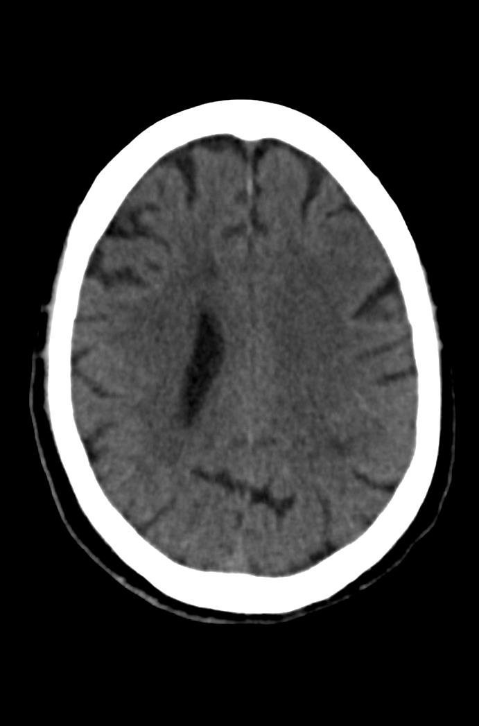 Artery of Percheron infarction (Radiopaedia 80613-94202 Axial non-contrast 128).jpg