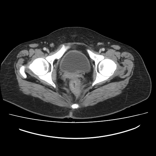 Ascending retrocecal appendicitis with liver abscesses (Radiopaedia 60066-67615 B 87).jpg