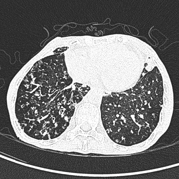 File:Aspergilloma- with Monod sign (Radiopaedia 44737-48532 Axial lung window 215).jpg