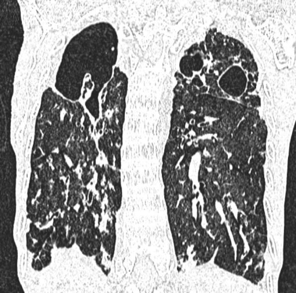 Aspergilloma- with Monod sign (Radiopaedia 44737-48532 Coronal lung window 333).jpg