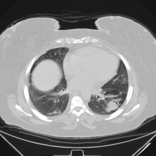 Aspergilloma (Radiopaedia 39611-41932 Axial lung window 78).jpg