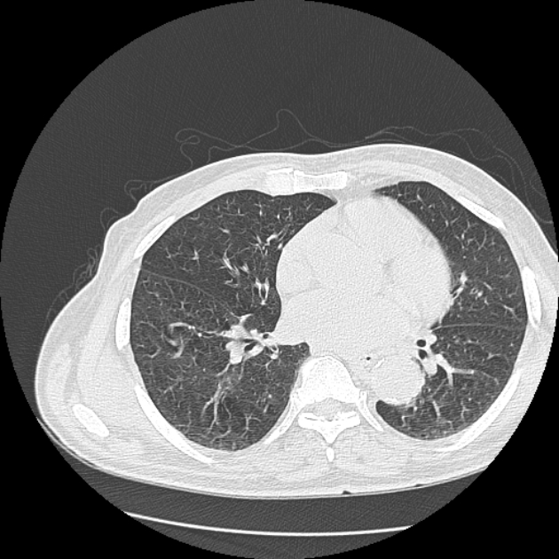 Aspergilloma (Radiopaedia 44592-48327 Axial lung window 53).jpg