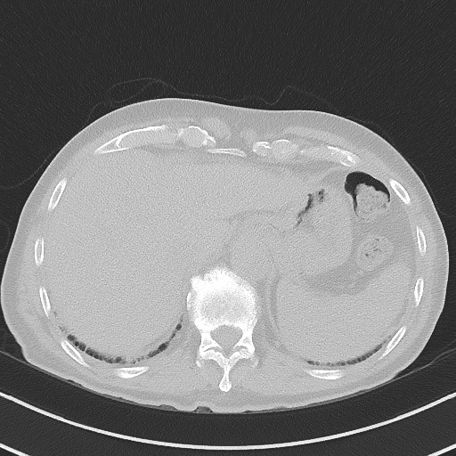 Aspergilloma on background pulmonary fibrosis (Radiopaedia 60942-68757 A 50).jpg