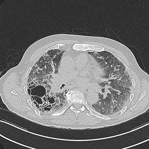 File:Aspergilloma on background pulmonary fibrosis (Radiopaedia 60942-68757 B 28).jpg