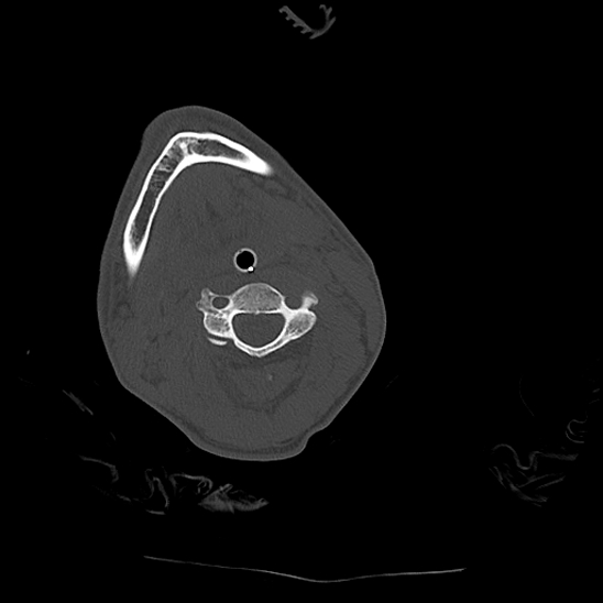 File:Atlanto-occipital dissociation (Traynelis type 1), C2 teardrop fracture, C6-7 facet joint dislocation (Radiopaedia 87655-104061 Axial bone window 40).jpg