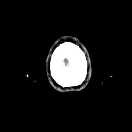 Atretic cephalocele (Radiopaedia 89782-106881 Axial with contrast 183).jpg