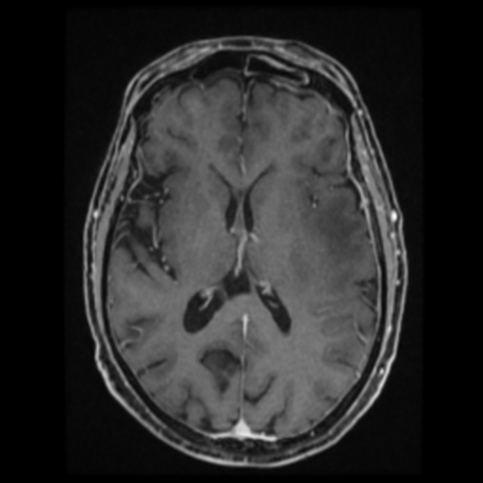 Atypical meningioma (Radiopaedia 45535-49629 Axial T1 C+ 40).jpg