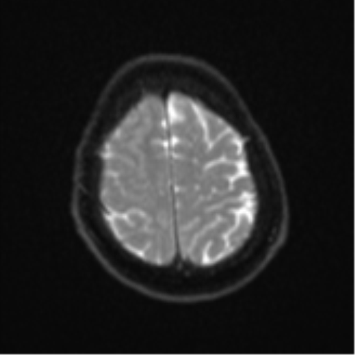Atypical meningioma (WHO Grade II) (Radiopaedia 54742-60979 Axial DWI 23).png
