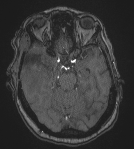 Atypical meningioma (WHO Grade II) (Radiopaedia 54742-60981 Axial MRA 36).png