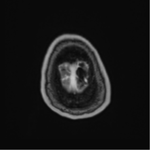 File:Atypical meningioma (WHO Grade II) (Radiopaedia 54742-60981 Axial T1 C+ 67).png