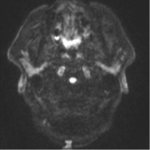 File:Atypical meningioma (WHO grade II) with brain invasion (Radiopaedia 57767-64729 Axial DWI 31).png