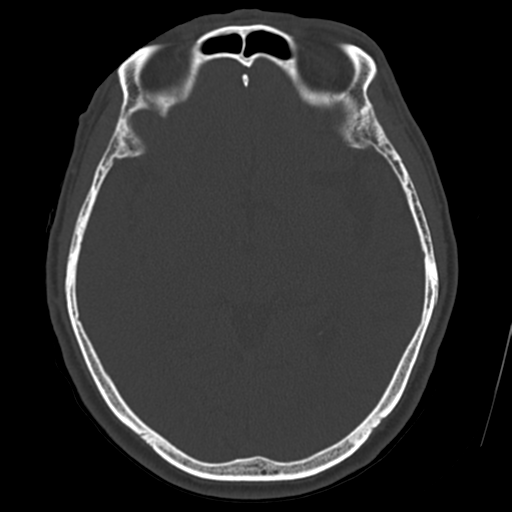 Atypical meningioma (WHO grade II) with osseous invasion (Radiopaedia 53654-59715 Axial bone window 38).png