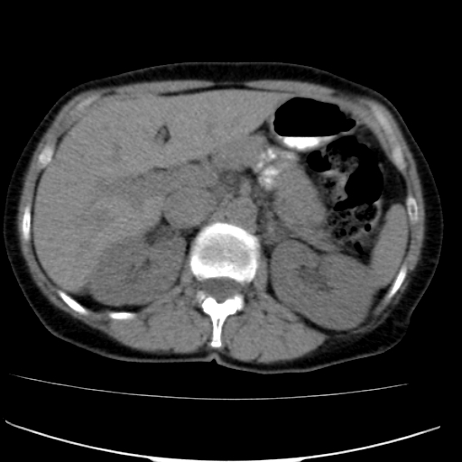 File:Atypical renal cyst (Radiopaedia 17536-17251 non-contrast 9).jpg