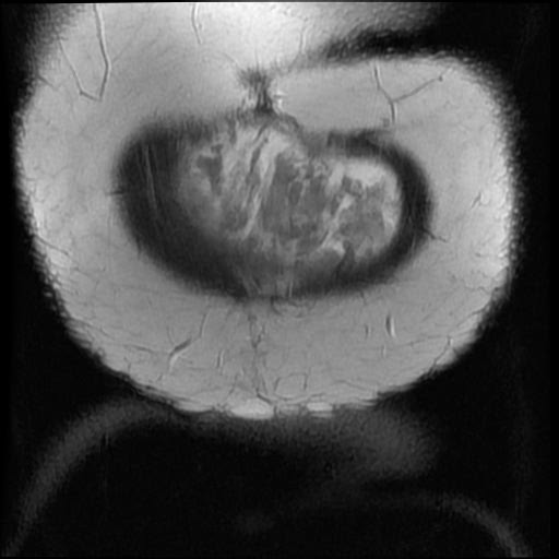 File:Atypical retroperitoneal lymphocoeles with large leiomyoma of uterus (Radiopaedia 32084-33027 Coronal T2 1).jpg