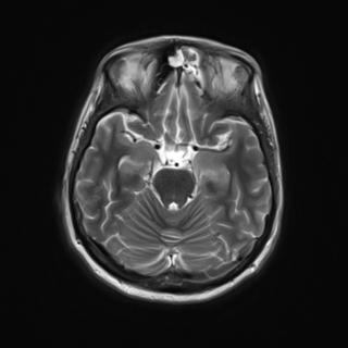 File:Autoimmune limbic encephalitis (Radiopaedia 30363-31005 Axial T2 12).jpg