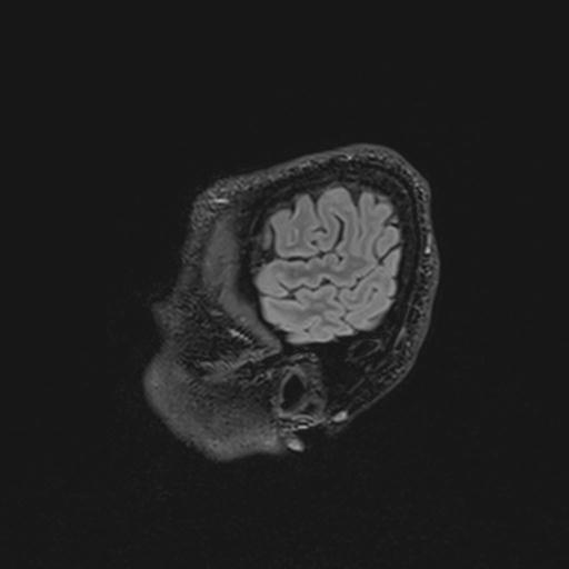 Autoimmune limbic encephalitis (Radiopaedia 30363-31005 Sagittal FLAIR 22).jpg