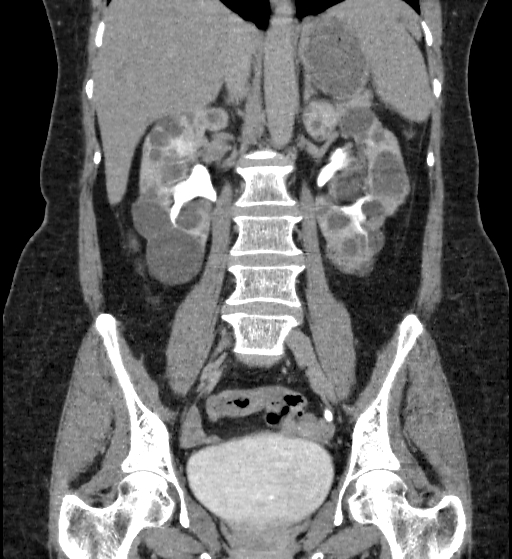 Autosomal dominant polycystic kidney disease (Radiopaedia 38189-40194 Coronal C+ delayed 53).jpg