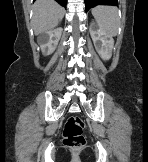 Autosomal dominant polycystic kidney disease (Radiopaedia 38189-40194 Coronal C+ delayed 83).jpg