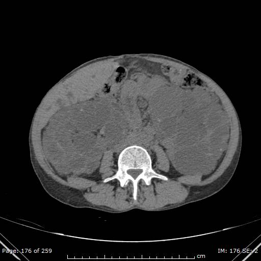 File:Autosomal dominant polycystic kidney disease (Radiopaedia 44122-47684 Axial 32).jpg