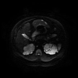 Autosomal dominant polycystic kidney disease (Radiopaedia 50259-55611 Axial DWI 53).jpg