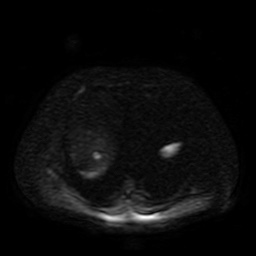 Autosomal dominant polycystic kidney disease (Radiopaedia 50259-55611 Axial DWI 76).jpg