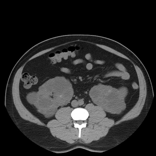 Autosomal dominant polycystic kidney disease (Radiopaedia 50259-55612 Axial non-contrast 47).jpg