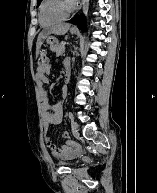 Autosomal dominant polycystic kidney disease (Radiopaedia 87830-104287 C 55).jpg