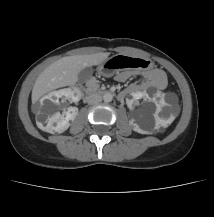 Autosomal dominant polycystic kidney disease - early onset (Radiopaedia 40734-43387 A 39).jpg