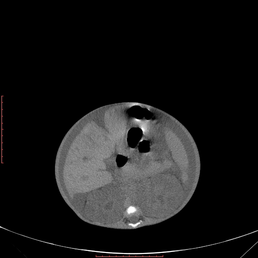 Autosomal recessive polycystic kidney disease associated with Caroli disease (Radiopaedia 61932-69984 Axial non-contrast 184).jpg