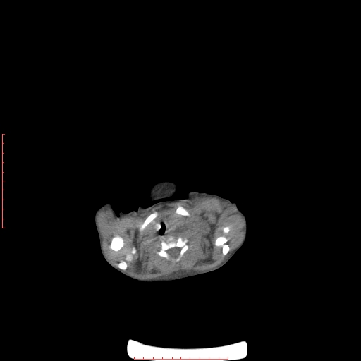 Autosomal recessive polycystic kidney disease associated with Caroli disease (Radiopaedia 61932-69984 B 4).jpg