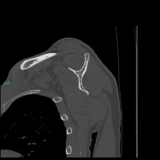 Avascular necrosis after fracture dislocations of the proximal humerus (Radiopaedia 88078-104655 Sagittal bone window 43).jpg