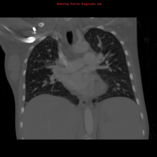 Avascular necrosis in sickle cell disease (Radiopaedia 17448-17152 Coronal bone window 66).jpg