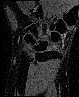 Avascular necrosis of the capitate (Radiopaedia 88317-104948 Coronal T1 vibe 49).jpg